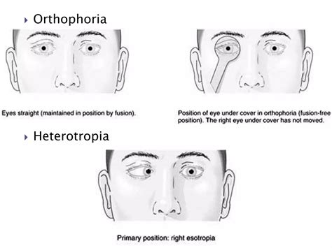 馬篤氏鏡原理|Motor Signs in Heterophoria and Heterotropia